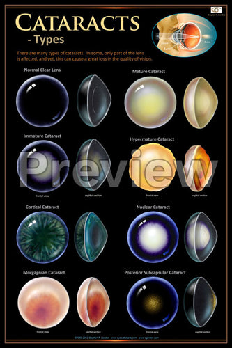 Cataract Types Poster