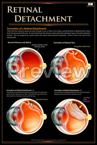 Retinal Detachment Poster